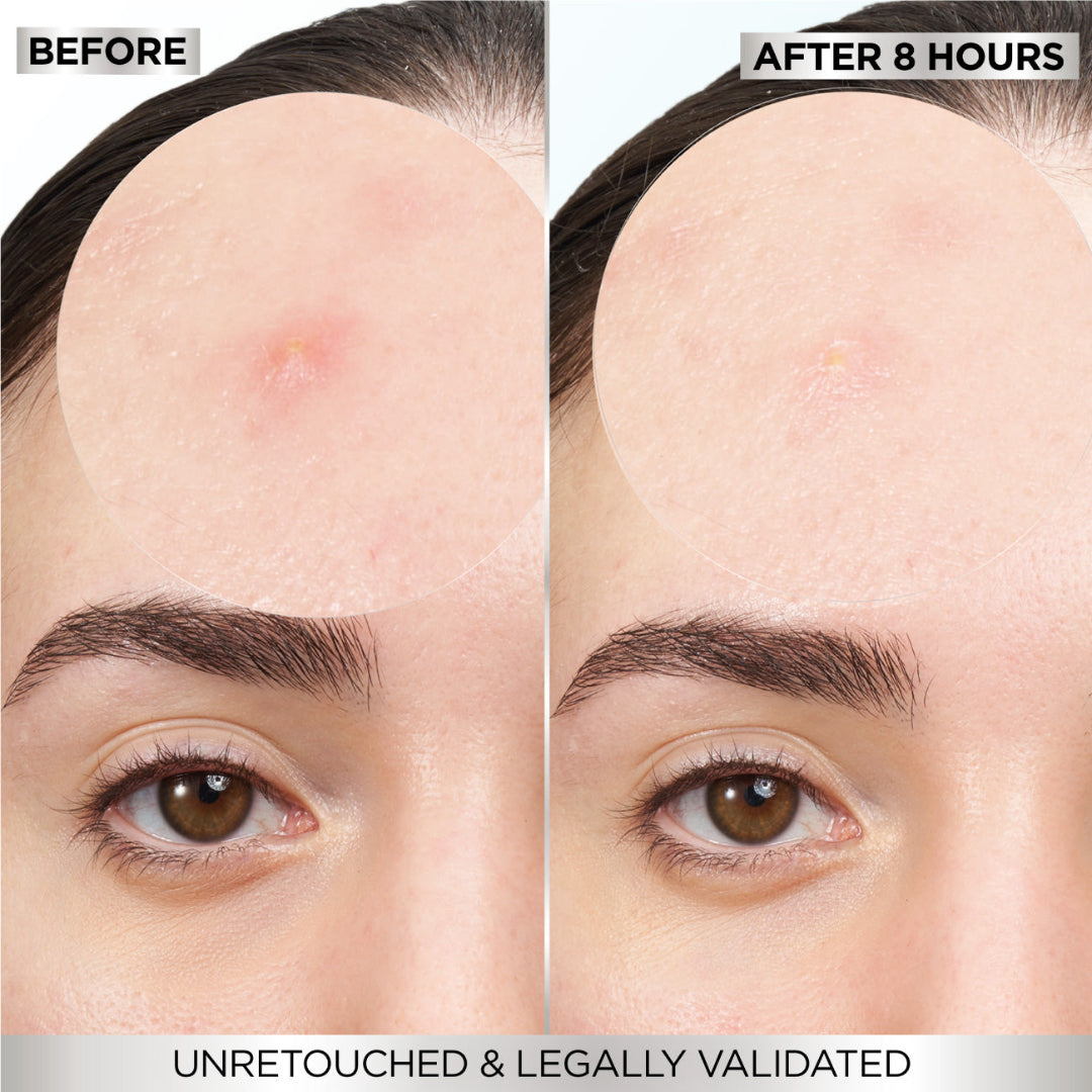 Skin Active Fast Clear Invisible Pimple Patch 8 Hours Hydrocolloid 22patches ​