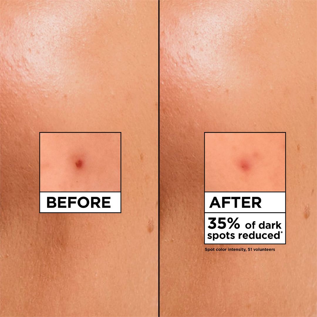 Before-and-after split screen showing a close-up of human skin with a small dark spot, labeled 'BEFORE' on the left and 'AFTER 35% of dark spots reduced' on the right, applicable fort eh Garnier Vitamin C cream
